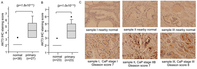 Protein expression of AKT3 in normal human prostate tissues versus prostate tumors.