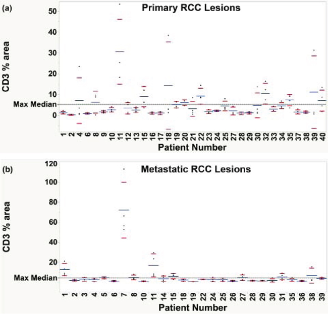 Examination of heterogeneity of the total T-cell infiltrate within primary and metastatic RCC lesions.