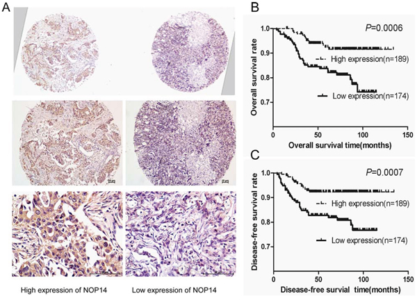 NOP14 expression in breast cancer TMA.