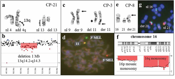 Combined results of G-banding, FISH, and microarray studies enable more accurate characterization of chromosomal aberrations in patients with hematological malignancies.