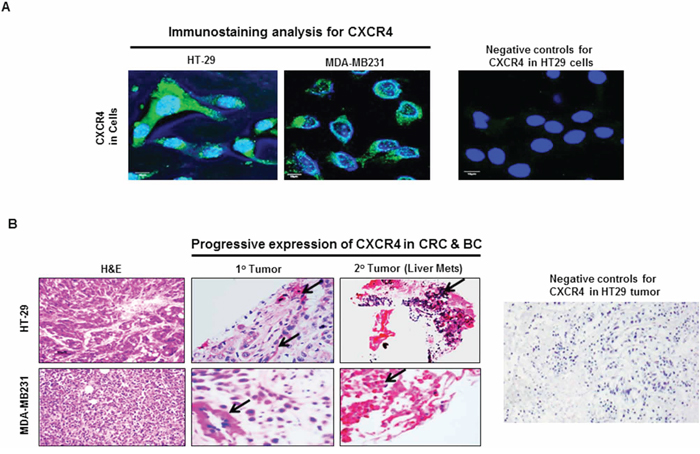 CXCR4 expression in CRC and BC by immunostaining.