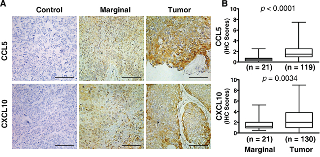 Elevated expression of CCL5 and CXCL10 in ESCC tissue.