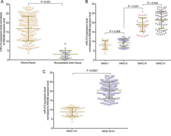 miR-215 overexpression in glioma tissues as detected by qRT-PCR assay.