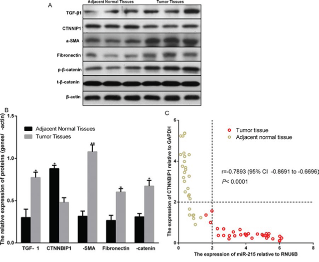 Expression comparison of TGF-&#x03B2;1, CTNNBIP1, &#x03B1;-SMA, and Fibronectin in human glioma tumor tissue and adjacent normal tissue.