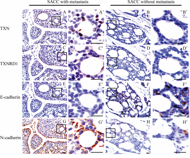 Immunohistochemical staining reveals differential expressions of thioredoxin 1 (TXN), thioredoxin reductase 1 (TXNRD1) and epithelial-mesenchymal transition signs in salivary adenoid cystic carcinoma (SACC) samples from patients with/without lung metastasis.