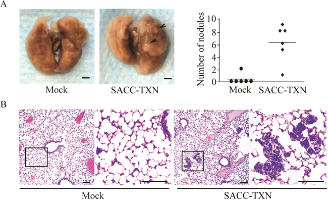 Overexpression of TXN enhances lung metastasis of SACC-83 cells in vivo.