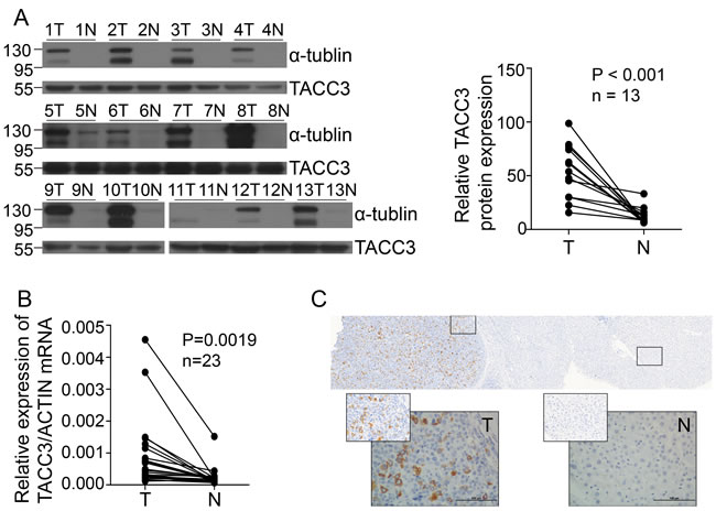 TACC3 expression is increased in HCC patients.