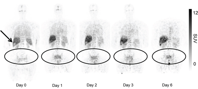 Uptake of 89Zr-cetuximab in patient 3 with tumor lesions in the pelvis and sacral bone.