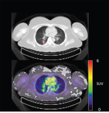 Figure 4B: 89Zr-cetuximab PET scan of patient 10 at day 6 p.i. with visible uptake in tumor lesion in the lower lobe of the right lung and low accumulation in surrounding healthy lung tissue.