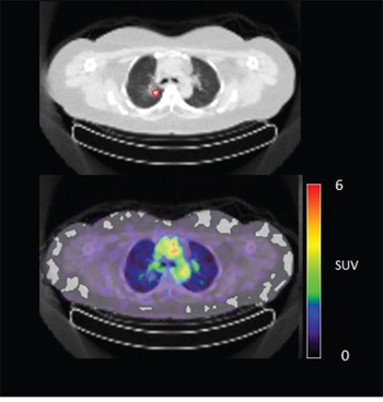 Figure 4C: 89Zr-cetuximab PET scan of patient 10 at day 6 p.i. without visible uptake in tumor lesion in the upper lobe of the right lung.