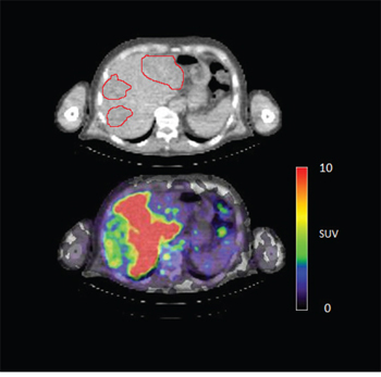 Figure 4D: 89Zr-cetuximab PET scan of patient 3 at day 6 p.i. illustrating high accumulation in healthy liver with relative photopenic area&#x0027;s in metastases.