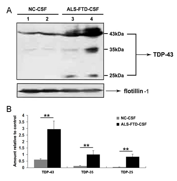 Full-length TDP-43 and TDP-43 CTFs are expressed in the exosomes derived from CSF.