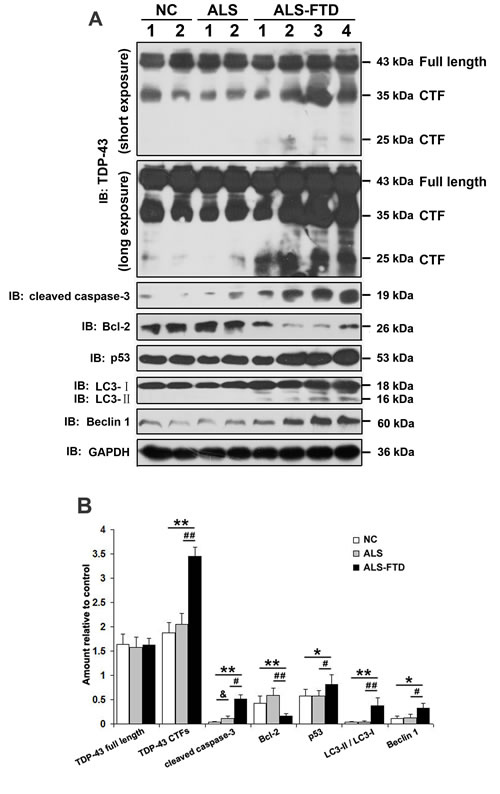 Exposure to ALS-FTD-CSF actives apoptosis and autophagy, and increases the expression of TDP-43 CTFs in U251 cells.