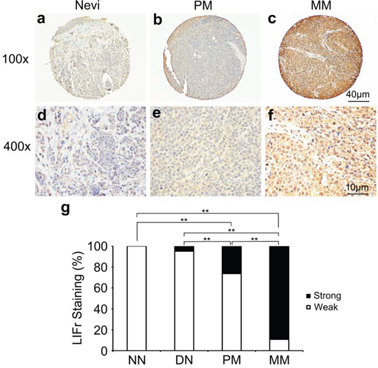 LIFr expression is increased in human advanced melanoma.