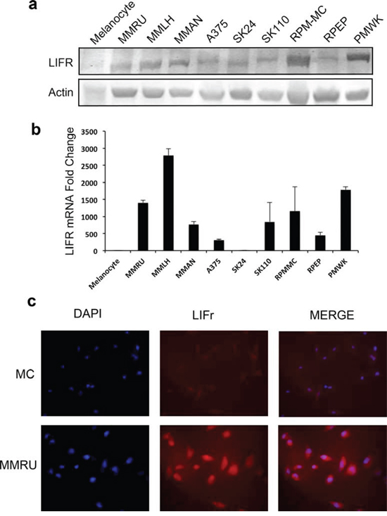 LIFr protein and mRNA expression are enhanced in melanoma cell lines compared with melanocytes.