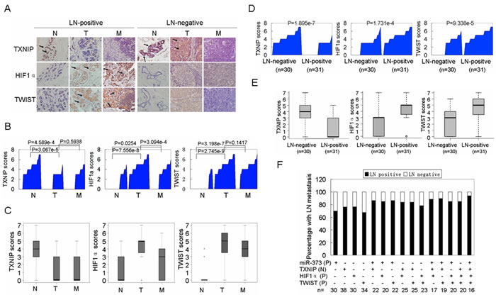 Activation of the miR-373-TXNIP-HIF1&#x3b1;-TWIST signaling axis is associated with worse outcomes in breast cancer patients.