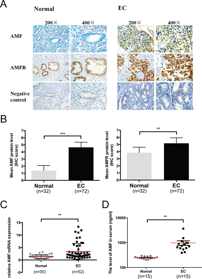 Autocrine motility factor is highly expressed in EC tissues and serum.