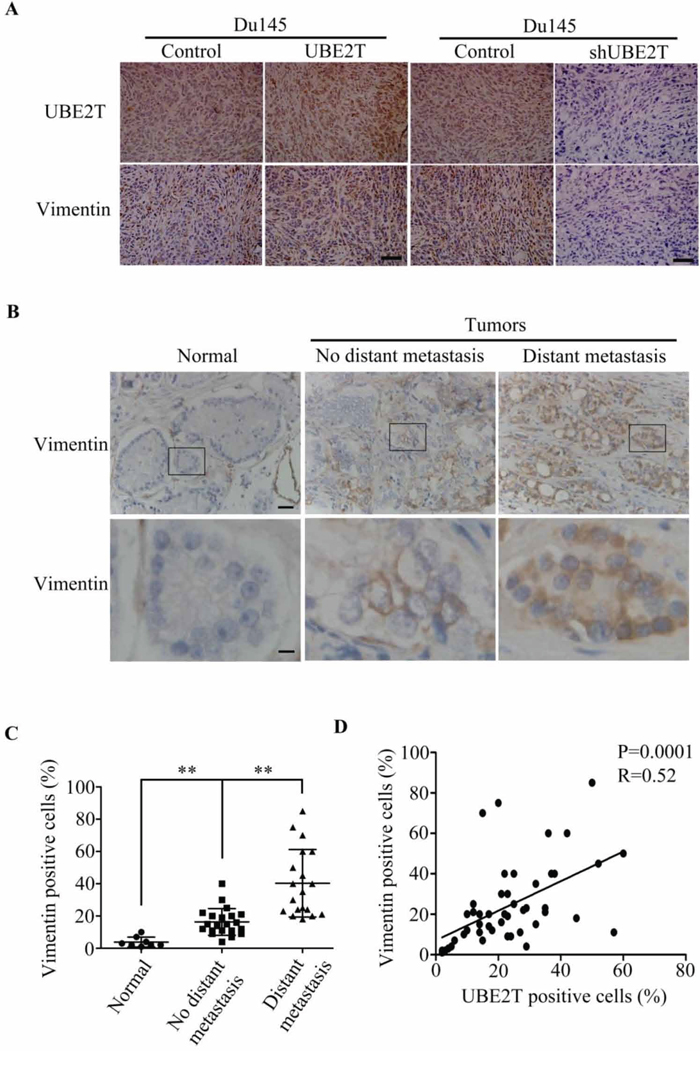 UBE2T expression level is positively associated with vimentin expression.