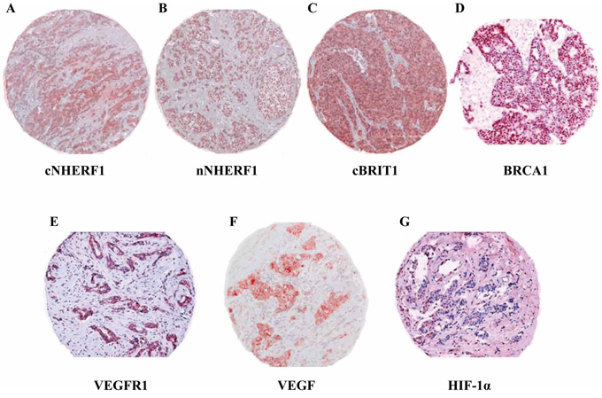 Expression of biomarkers studied by immunohistochemistry on tissue microarrays.