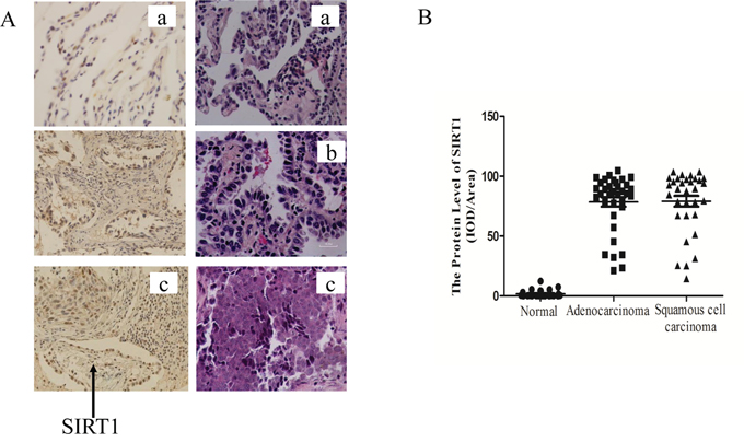 SIRT1 was up-regulated in human lung cancer biopsies.