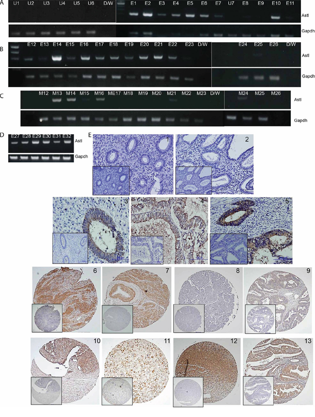 SAS1B expression occurs at high incidence in uterine tumors.