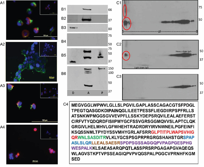 Membrane associated SAS1B in primary endometrioid cells and MMMT cell lines.