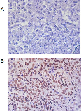 Immunohistochemical staining of melanoma tissue sections demonstrating p-STAT3 staining confined to the nucleus.