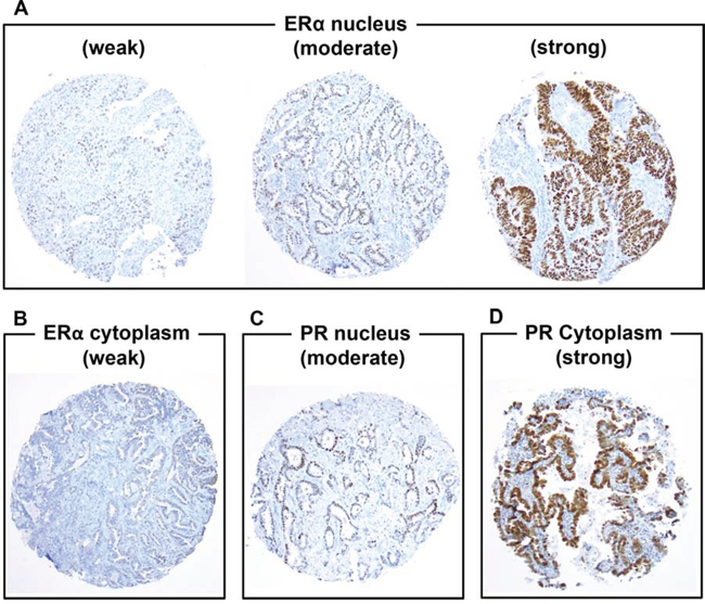 Immunohistochemical analyses of estrogen receptor-&#x03B1; (ER&#x03B1;) and progesterone receptor (PR) using tissue microarrays (original magnification, A&#x2013;F: &#x00D7; 100 magnification)