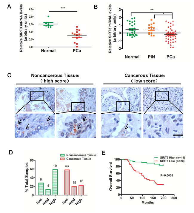 SIRT3 is down-regulated in human prostate carcinoma.