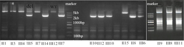 One deletion (exon 14&ndash;15 and intron 14) confirmed by long-range PCR.