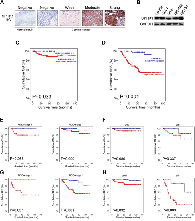 SPHK1 overexpression in human cervical cancer and its prognostic significance.