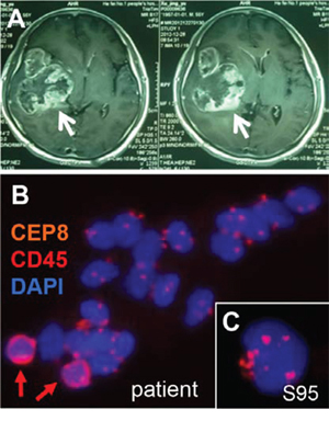 Detection of heteroploid glioma tumor cells disseminated in cerebrospinal fluid of a malignant glioma patient.