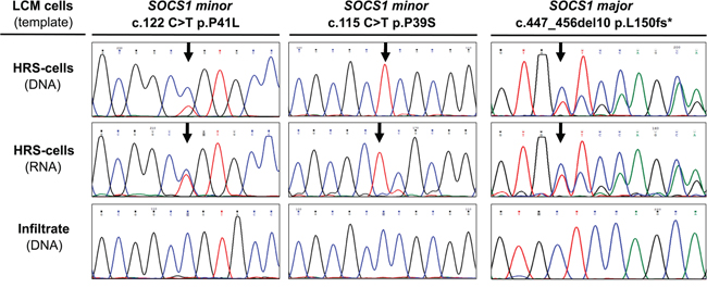 Expression of SOCS1 Mutations in Hodgkin/Reed-Sternberg (HRS cells in classical Hodgkin Lymphoma (cHL).