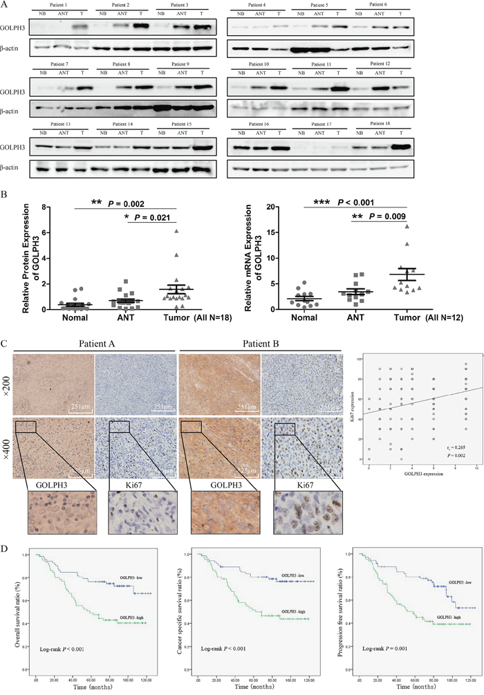 GOLPH3 expression is increased in human bladder cancer tissues and is related to the expression of Ki67 and the prognosis of patients.