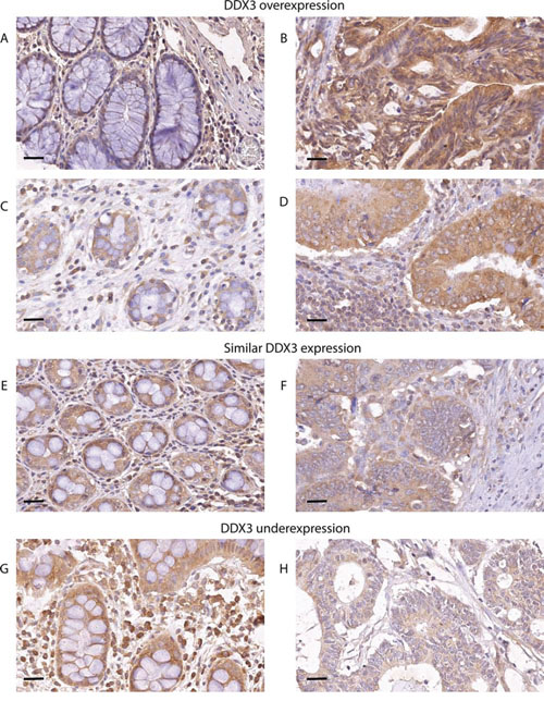 DDX3 is overexpressed in patients with colorectal cancer.