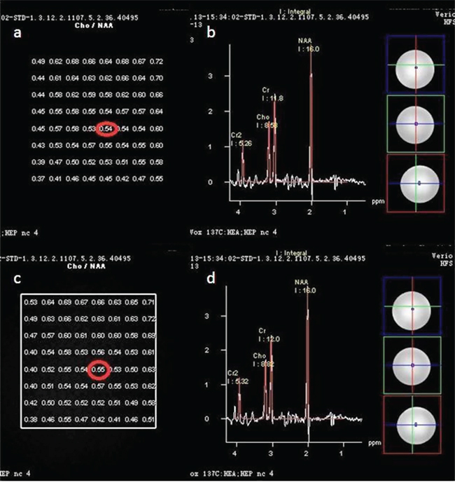 In phantom study totally 64 points to points Cho/NAA ratio in 0 min&#x2019;s scan a. did not differ from 6 min&#x2019;s 1c.