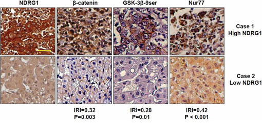 Expression of NDRG1, &#x03B2;-catenin, GSK-3&#x03B2; 9ser, and Nur77 in HCC patients.