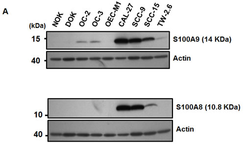 Frequent alteration of S100A9 protein in oral cancer and its impacts on patient clinical outcome.