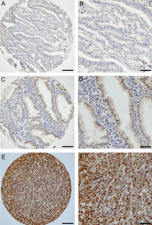 Immunohistochemical detection of ATAD2 protein in endometrial carcinomas.