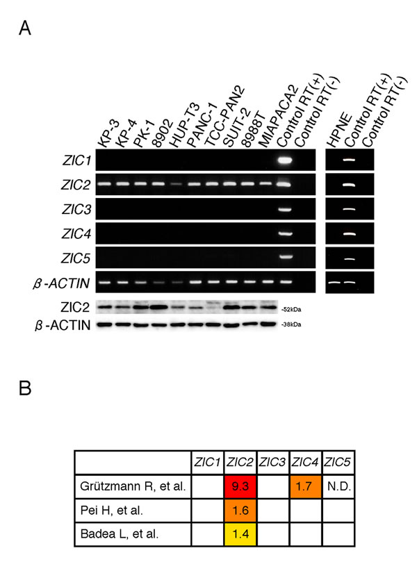 ZIC2 is uniquely expressed in PDAC cells.