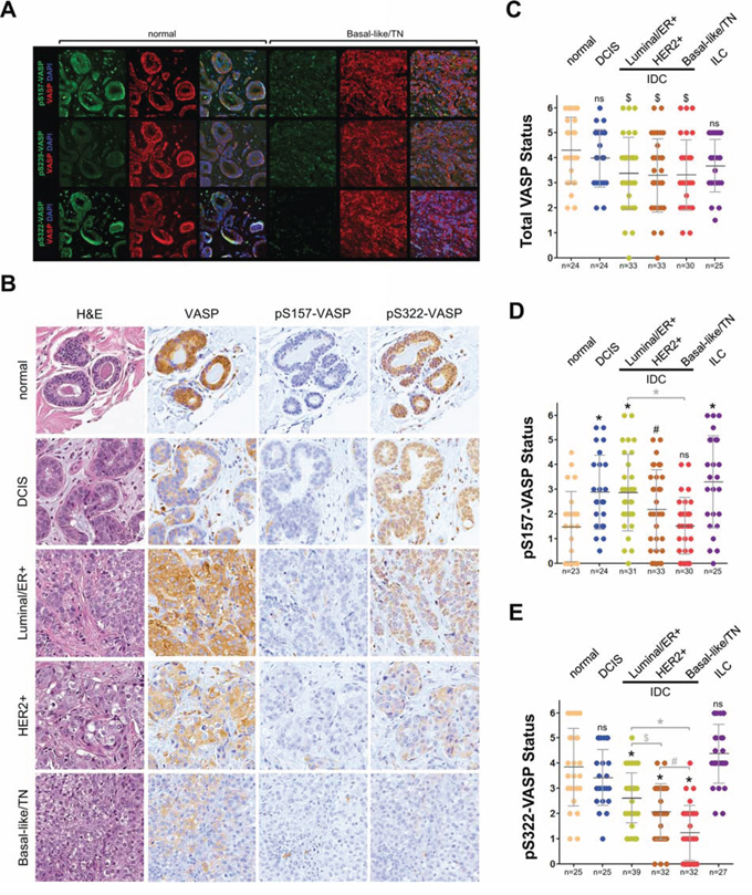 Phosphorylation of VASP at S157 and S322 is decreased in triple-negative breast cancer.