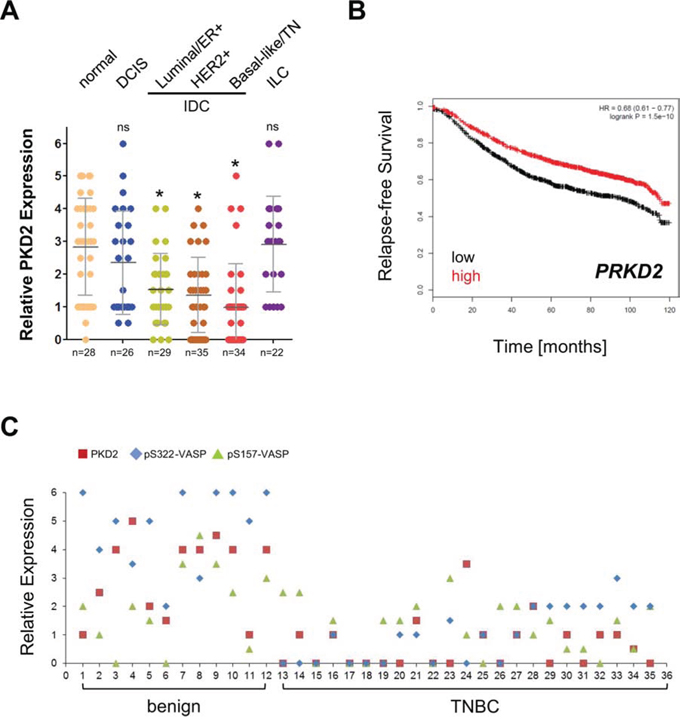 The expression of the S157/S322 kinase PKD2 is decreased in IDC and relative expression levels predict RFS.