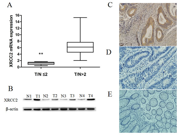 XRCC2 expression in the resected specimens that did not receive PRT.
