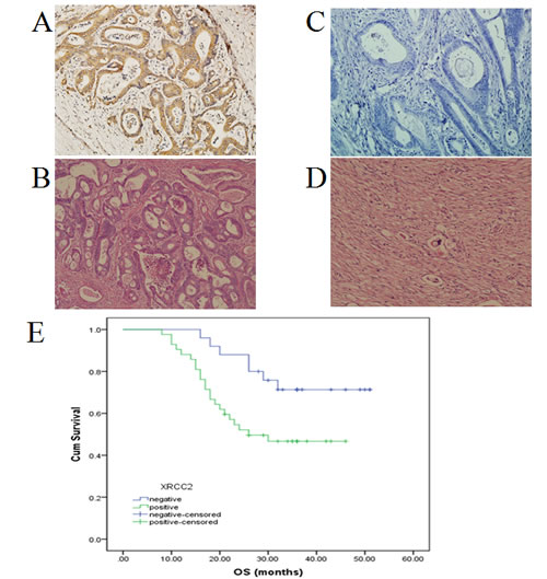 Decreased XRCC2 expression in pretreatment biopsy tissue samples of LARC patients who received PRT is associated with improved postoperative histological tumor regression and better long-term prognosis.