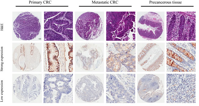 Representatives of ANO9 expression in consecutive TMA slides consisting of 75 non-tumor, primary, and metastatic CRC tissues detected by immunohistochemistry (magnification&times;40 or 400).