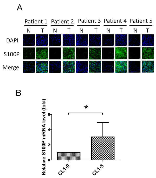 Elevated S100P expression in highly invasive lung cancer cells and tumor regions.