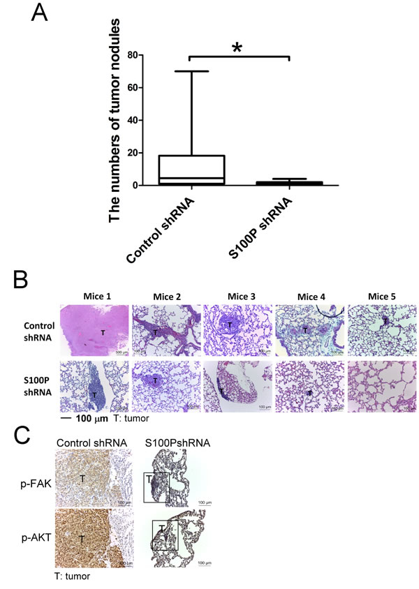 Inhibition of S100P decreased lung cancer metastasis