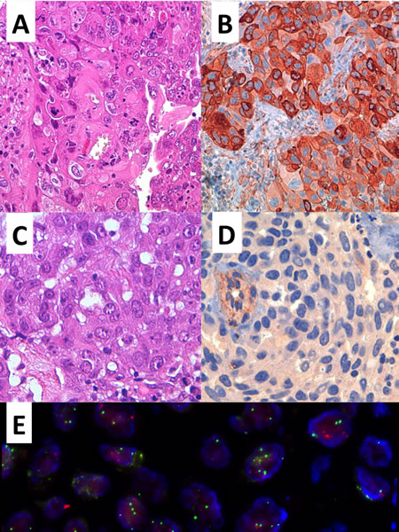Representative examples of two brain metastasis from lung adenocarcinoma (A, C hematoxylin &amp; Eosin, original magnification 400X) with mild to strong membrane-cytoplasmic immunoreactivity and negative staining for Cav1 (respectively B, D original magnification 400X) and high CAV1 gene polysomy by FISH analysis (E).