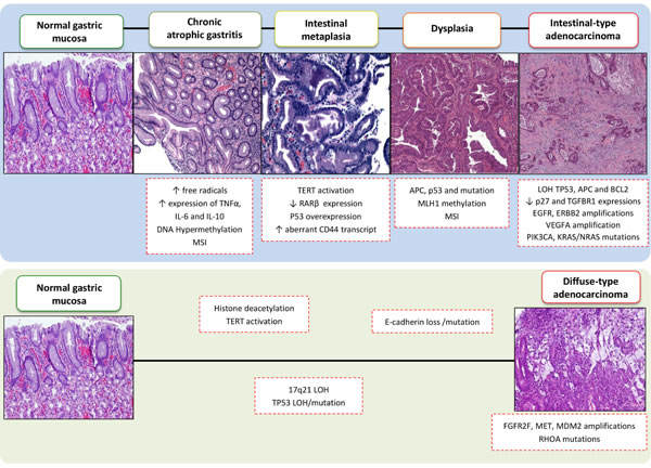 Sequential morphologic, genetic and epigenetic alterations in multistep gastric carcinogenesis.