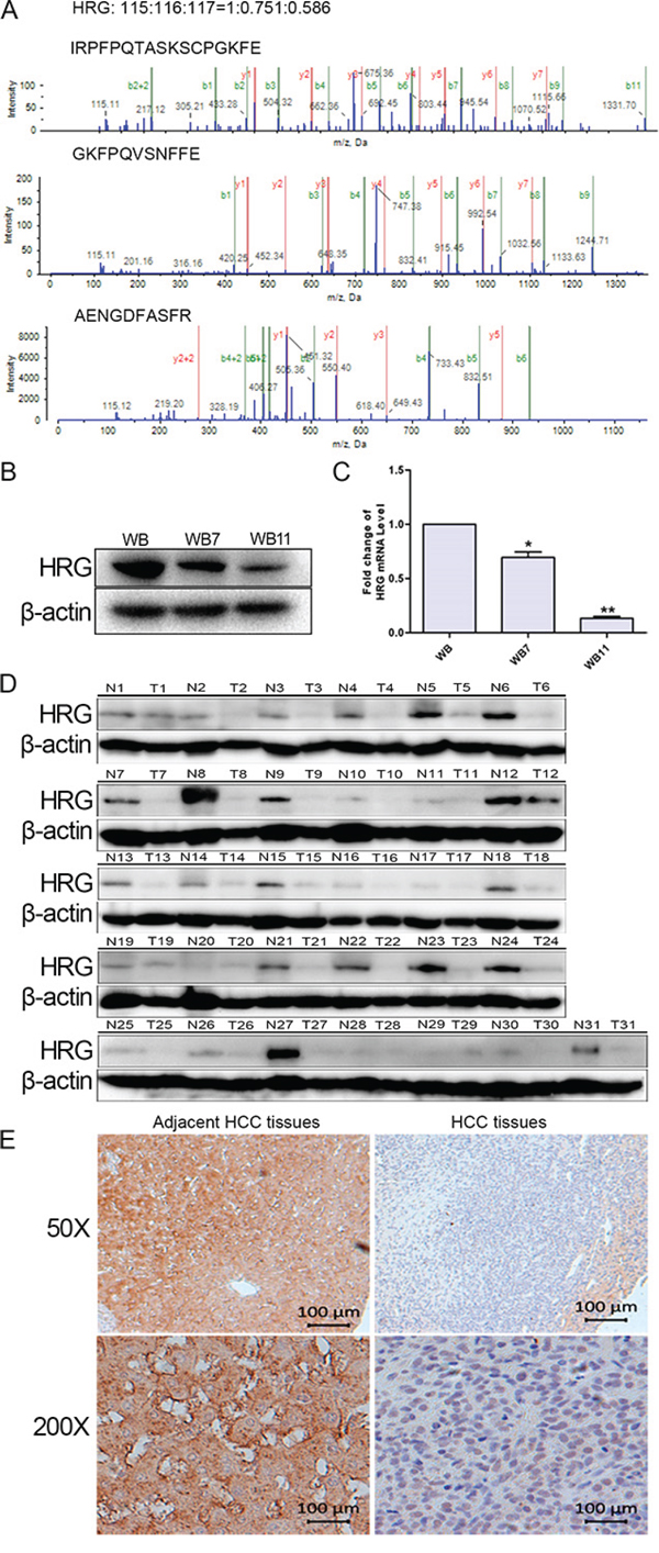 Validation of HRG expression in both neoplastic transformation and HCC tissues.